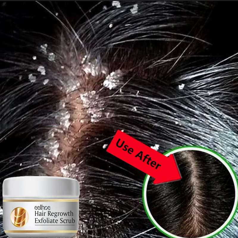 Scalp Scrub Exfoliant - 速効性フケ防止ヘアトリートメントスクラブ かゆみ止め頭皮洗浄角質除去製品 オイルコントロール鎮痒ヘアケア