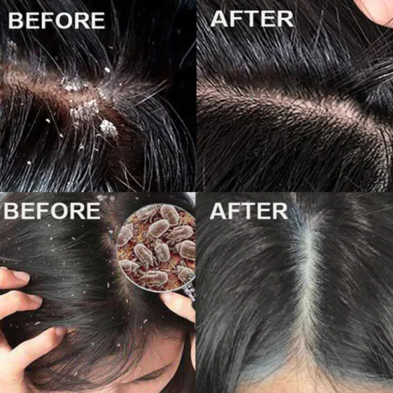 速効性フケ防止ヘアトリートメントスクラブ かゆみ止め頭皮洗浄 - Scalp Scrub Exfoliant のレビューと価格