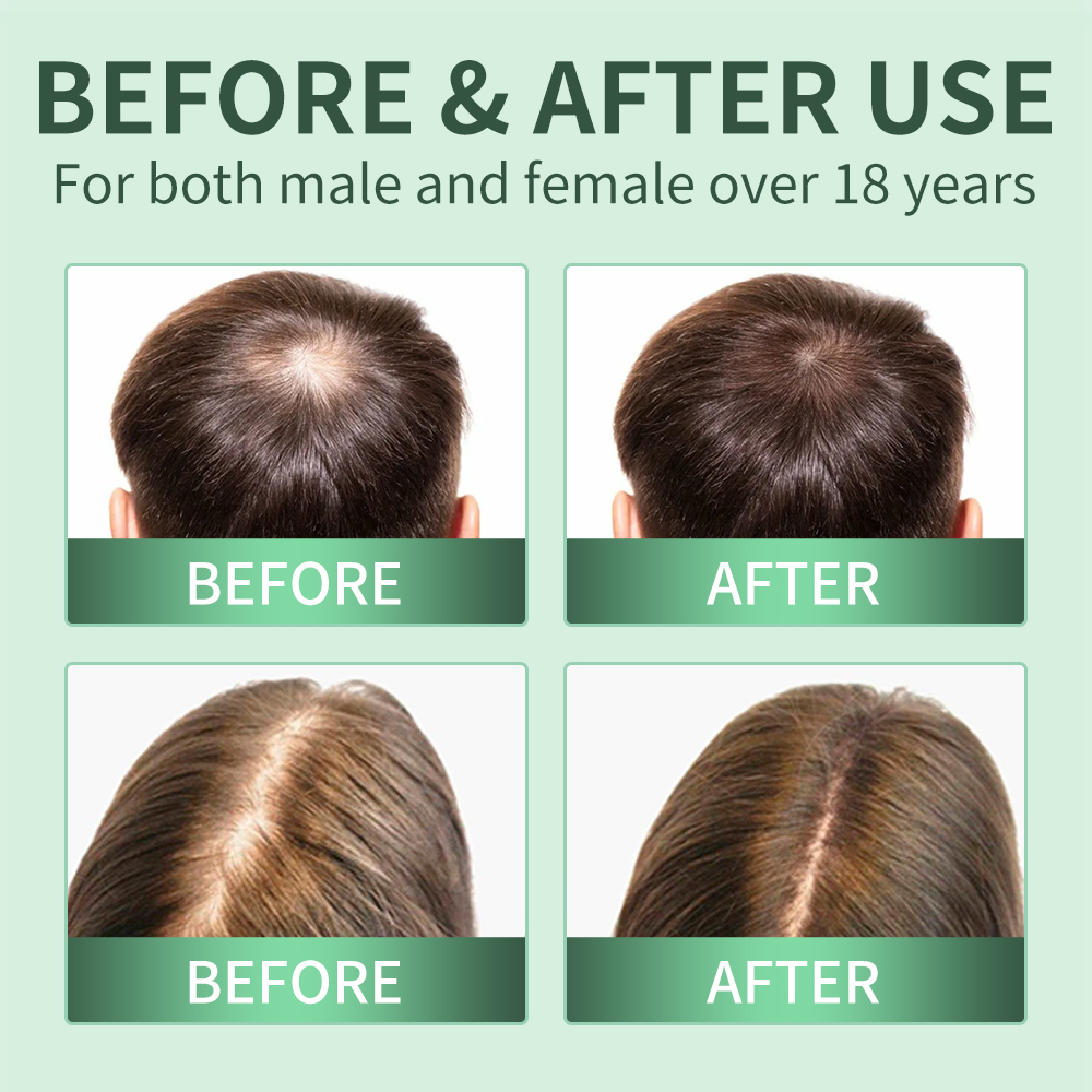 育毛スプレー、頭皮スクラブ、ローズマリー頭皮角質除去スクラブ - Scalp Scrub Exfoliant のレビューと価格