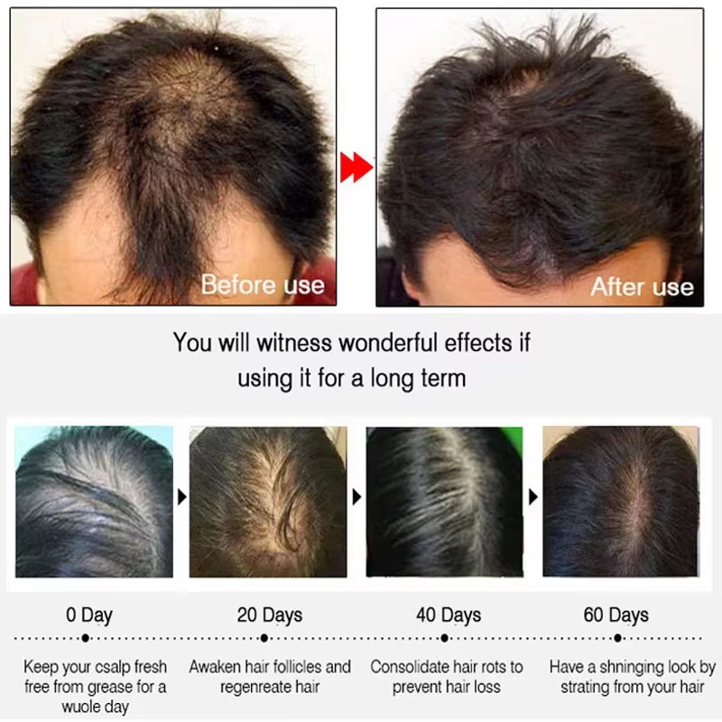 速効性ジンジャーヘアグローススプレー、毛根育成、脱毛防止、育 - Hair Care Serum のレビューと価格